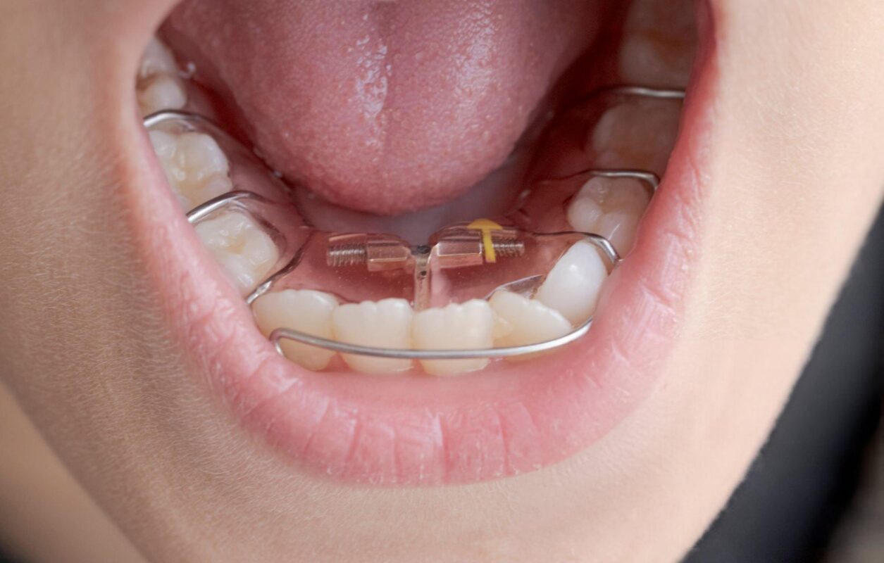 Palatal Expanders