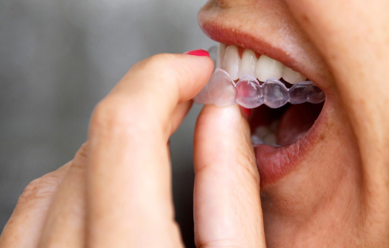 clear aligners