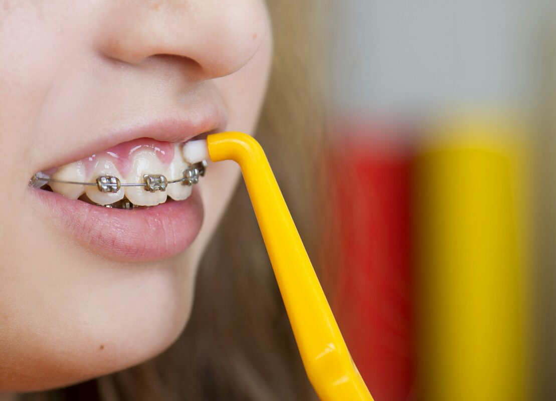 ceramic braces