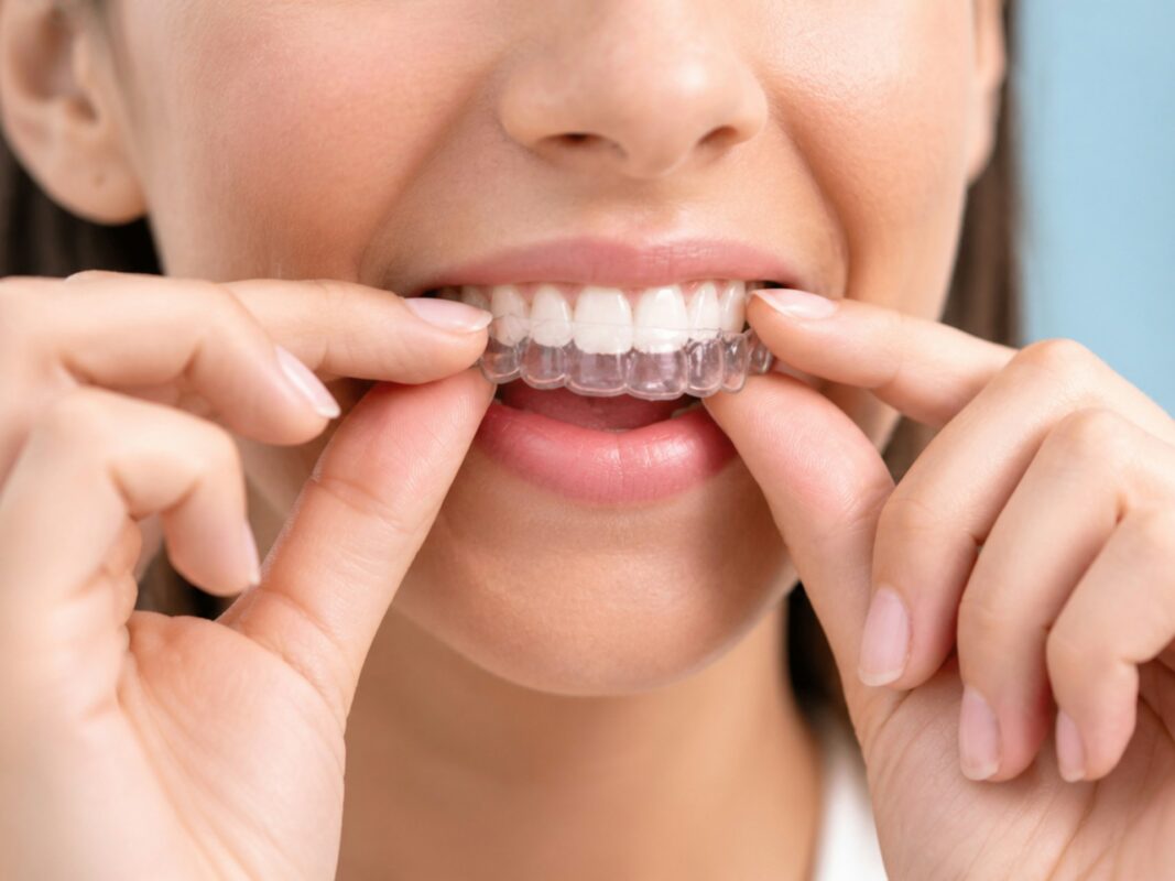 Clear Aligners for Teens